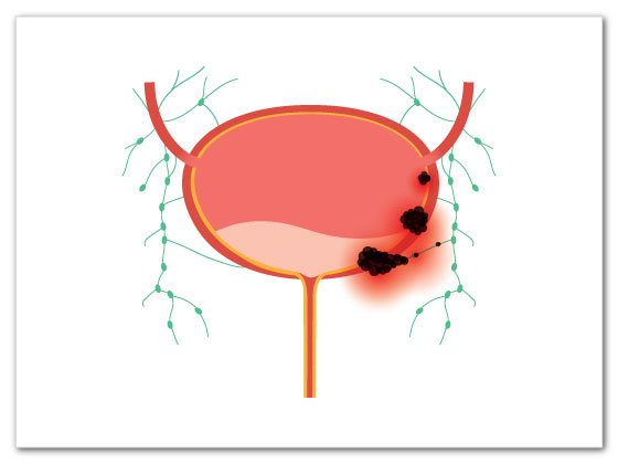 best-bladder-cancer-treatment-in-Habsiguda