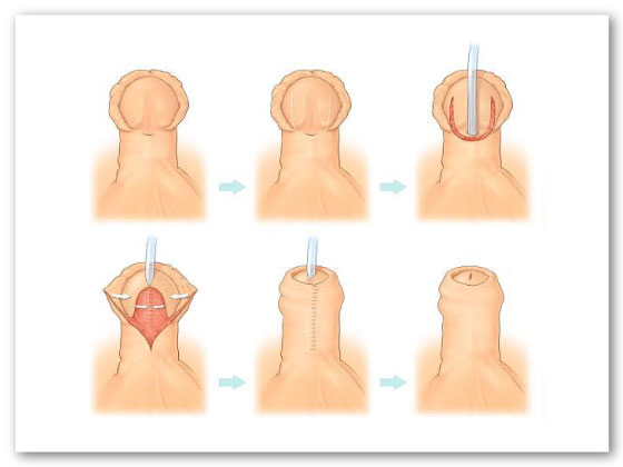 best-hypospadiasis-surgery-in-Habsiguda