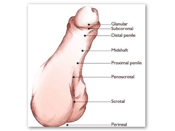 best-hypospadiasis-treatment-in-Habsiguda