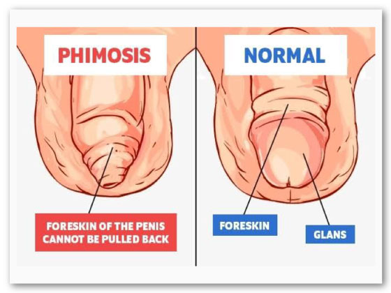 best-phimosis-treatment-in-Habsiguda