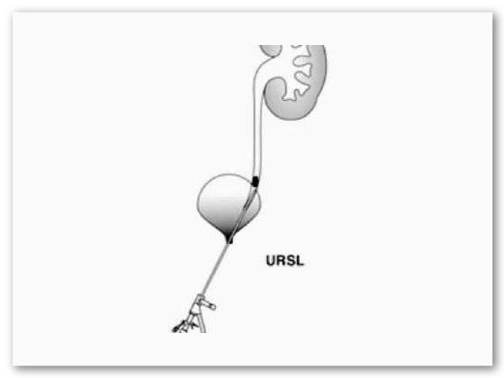 best-Ureteroscopic-lithotripsy-in-Habsiguda