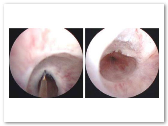 best-Visual Internal Urethrotomy-in-Habsiguda